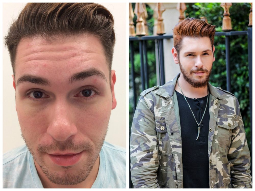 luh antes e depois botox masculino